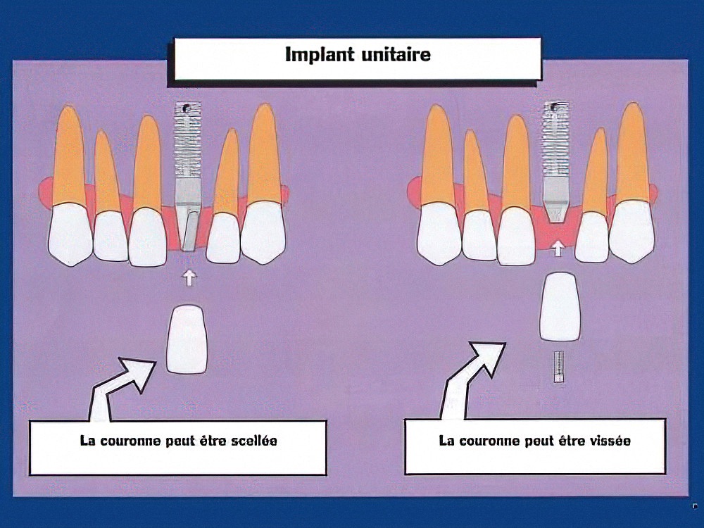 Différences entre dents et implants